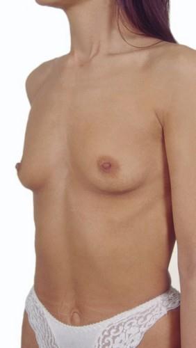 Stav před zvětšením prsu implantáty